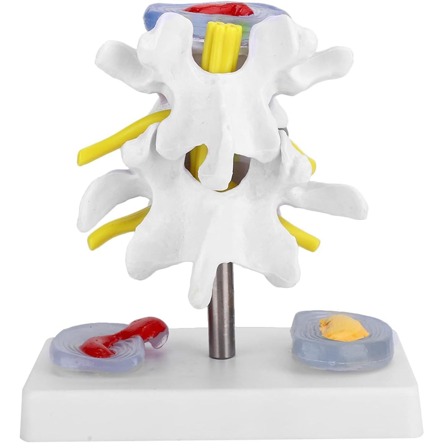 Human Spine Model, Anatomical Lumbar Disc Herniation Demonstration Model School Training Skeleton Spine Model Educational Tool for Exhibitions