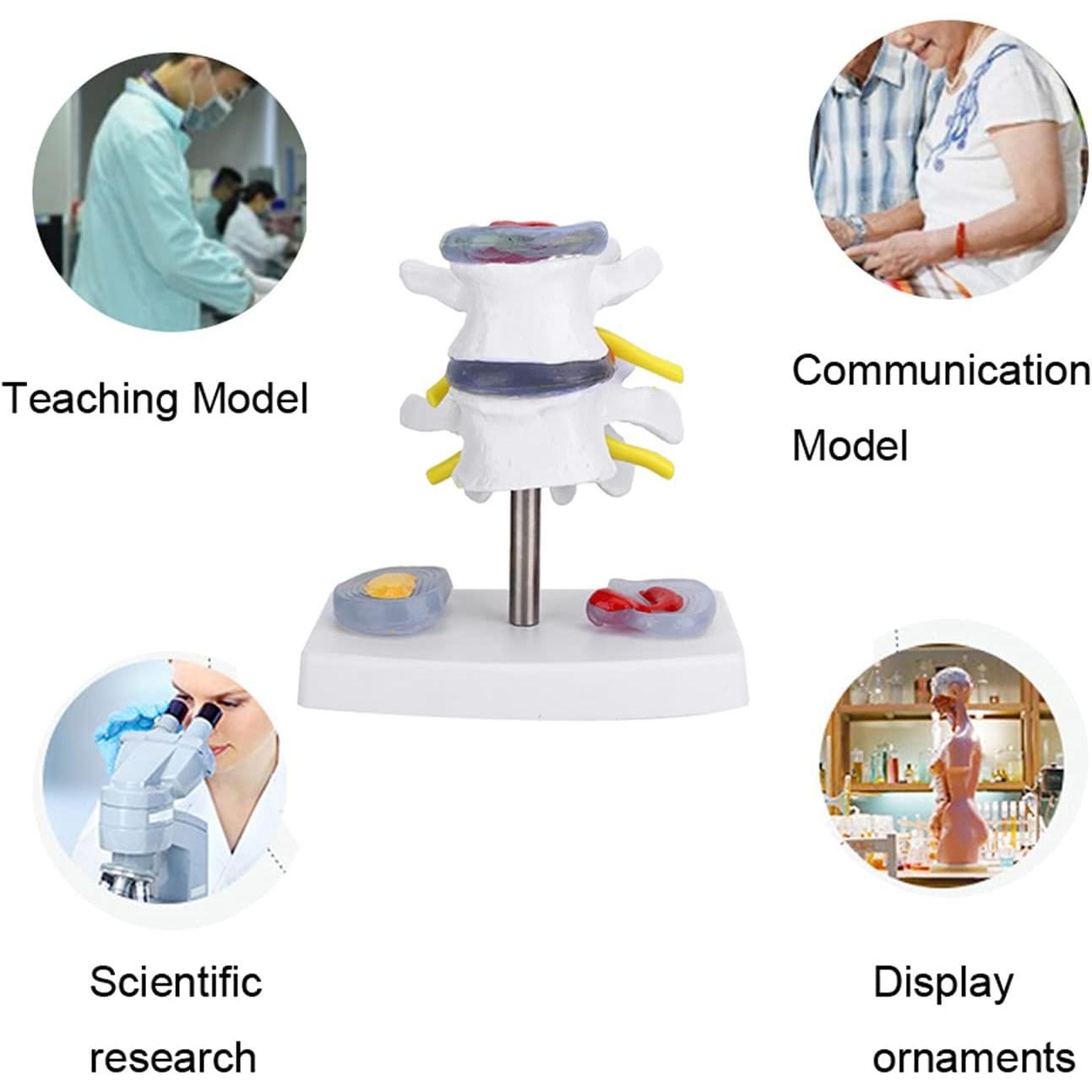 Human Spine Model, Anatomical Lumbar Disc Herniation Demonstration Model School Training Skeleton Spine Model Educational Tool for Exhibitions