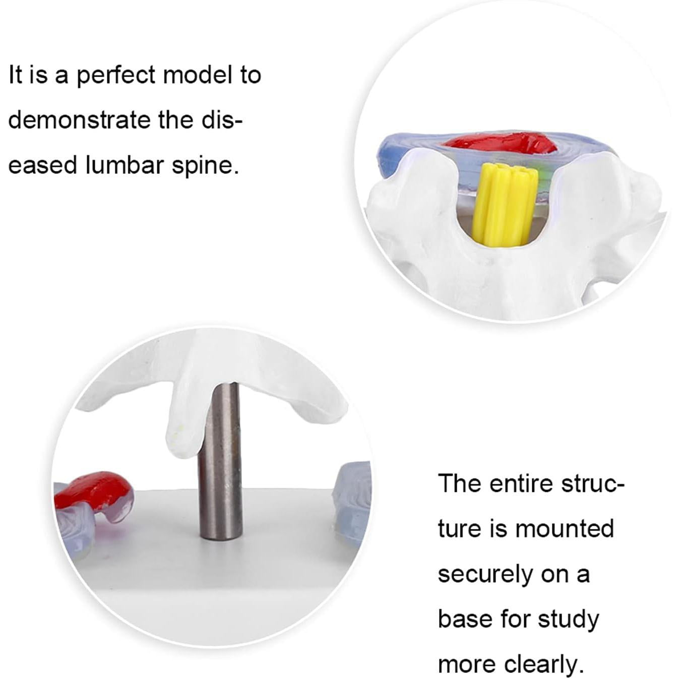 Human Spine Model, Anatomical Lumbar Disc Herniation Demonstration Model School Training Skeleton Spine Model Educational Tool for Exhibitions